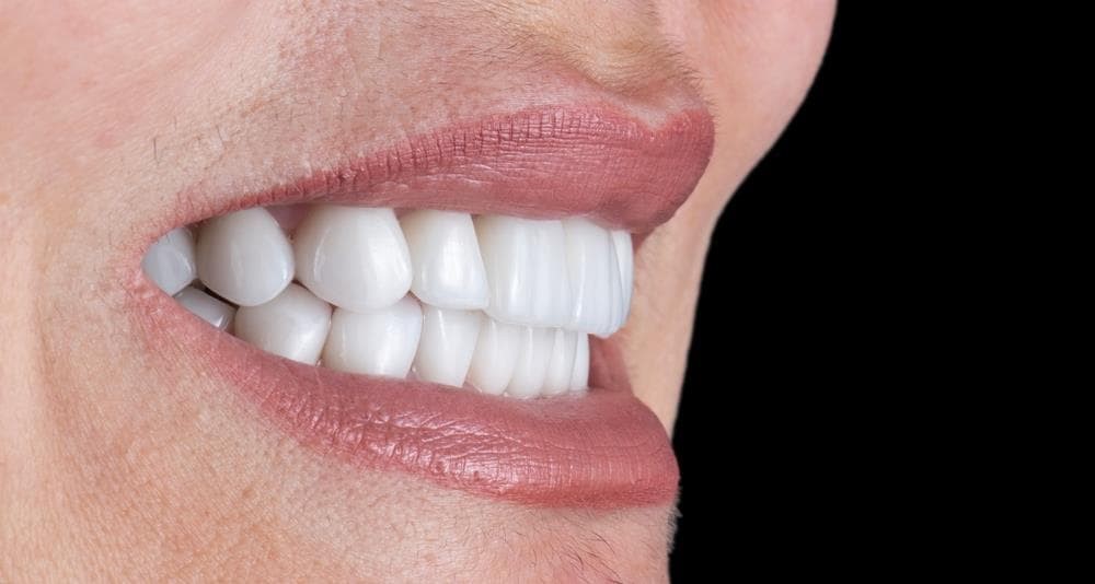 ¿Qué cuidados necesitan los implantes dentales?