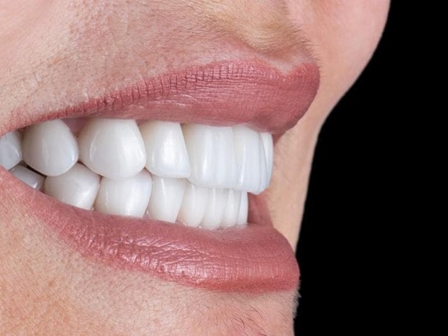 ¿Qué cuidados necesitan los implantes dentales?